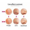 Pimple Popper Tool Set,7 Pcs Blackhead Remover Stainless Acne Comedone Extractor