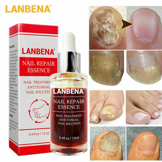 Ginger Antibacterial Fungal Nail Treatment Nail Repair Essential Oil Serum 12ml