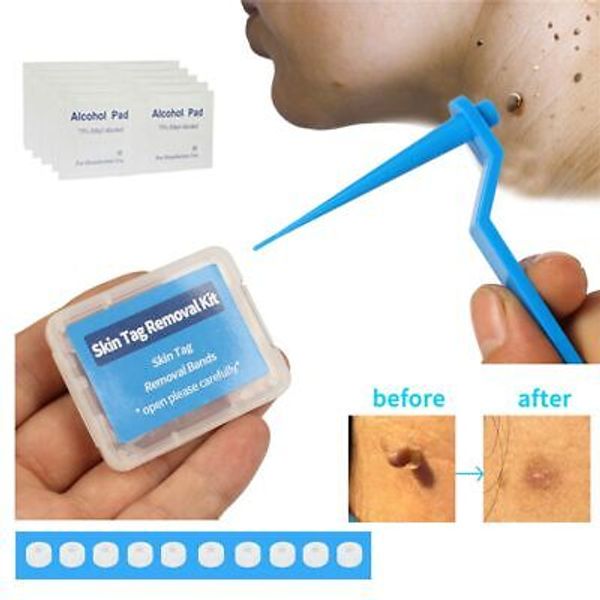 Rubber Bands Skin Tag Removal Kit Skin Tag Remover Mole Wart Tool Face Care