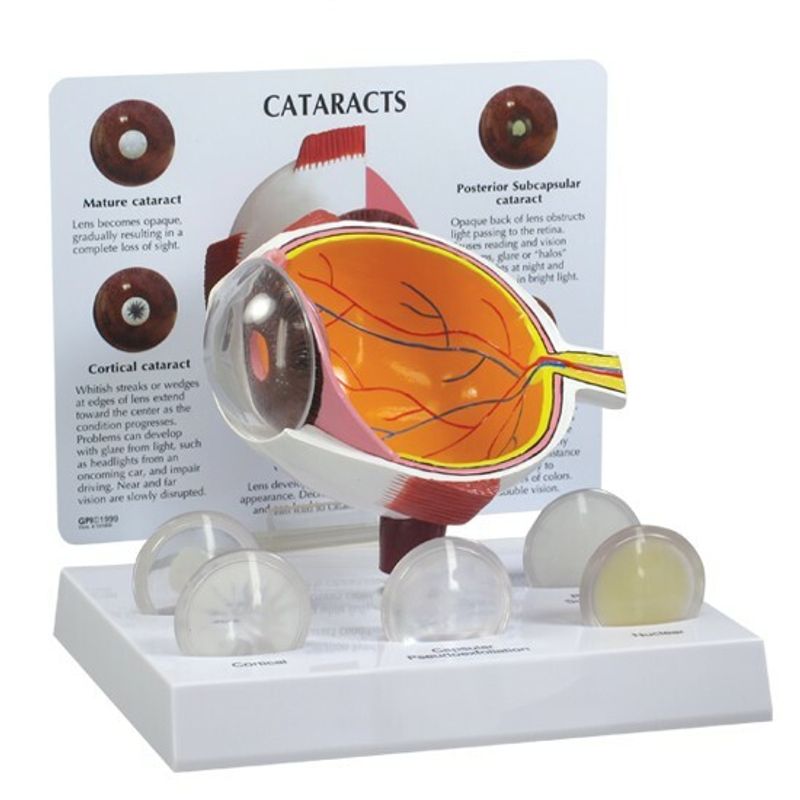 Cataract Eye Set of Five Lens Anatomical Model LFA#2800 SEE VIDEO Make ...
