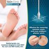 Effective Home Wart Removal with Advanced Cryotherapy and Precision Applicators