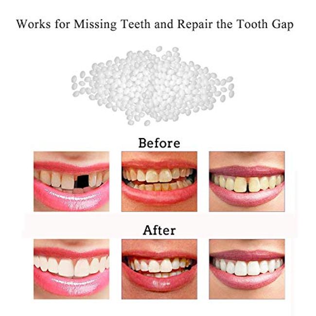 Tooth Repair Kit for Fixing the Missing Chipped and Broken Tooth Gap  Temporary Replacement Thermal Beads and Fake Teeth Brace Mold