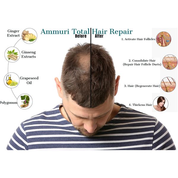 Ammuri Total Hair Repair Growth Serum Natural Herbal Anti Hair Loss Serum, For Balding, Thinning Repairs Hair Follicles & Promotes Thicker Regrowth for Men and Women