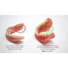 Lower Denture Stabilizers