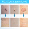 Piegricdiat WART Remover, Skin Tag Removal Kit