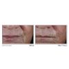 RoC Retinol Correxion Deep Wrinkle Non-Invasive Targeted Patches with Hyaluronic Acid + Firming Peptides for Forehead and Between Eyes 11 Lines, Crow’s Feet and Laugh Lines