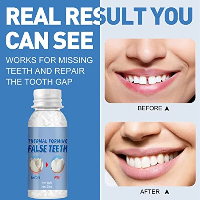 Tooth Repair Kit - Teeth Replacement Kit for Temporary Restoration of  Missing & Broken Teeth Replacement Dentures, DIY Heat Fit Beads