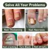 2PCS Ginger Nail Serum Solution, Ginger Cuticle Care Oil for Nails