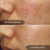 Power Clear D-BLEMISH Clearing Cleansing Gel Mini - Acne + Rosacea