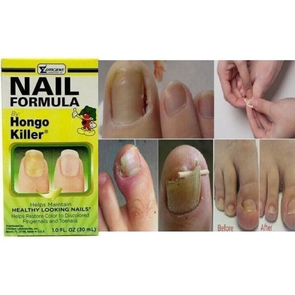 NAIL FORMULA by HONGO KILLER Helps Maintain Healthy Looking Nails 1oz
