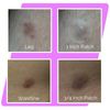 EXTRA LARGE/JUMBO Dots For Large Acne Zits, Boils, Larger Spot Patches PLAIN