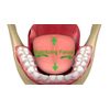 Lower Denture Stabilizers