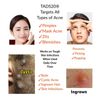 5pk [200] Acne Dot Pimple Patches [8mm SMALL] Hydrocolloid Patch [TEA TREE/MINT]