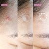 On the Go Blemish Patch/Hydrocolloid Spot/Treatment Pimples (108 counts)