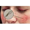Demodexcillin Skin Solution 4 Fl.Oz Recommended For Acne, Rosacea, Blepharitis
