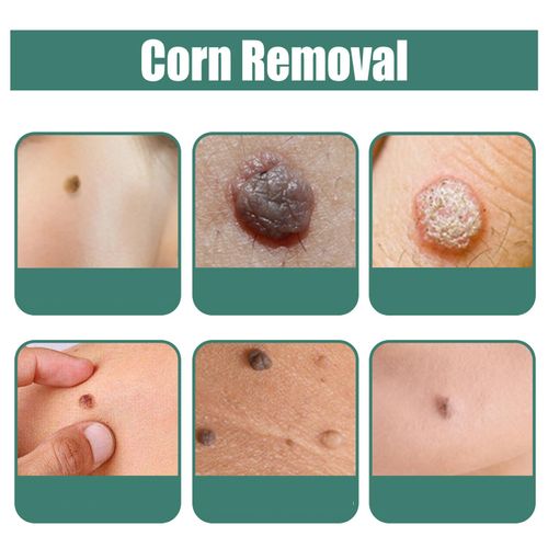 Corn Remover for Hands & Feet Skin, Corns Skin T-G-Removal Liquid, Corns Remover with Natural Ingredients Liquid, Deep Into Corns Remove, Easy to Use at Home (1PCS)