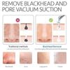 Comedo Suction Tool. Black/white Head Remover,Pore Cleanser.