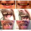 Thermal Fitting Beads, Fix Missing and Broken Teeth, Instant Smile –Pack 12