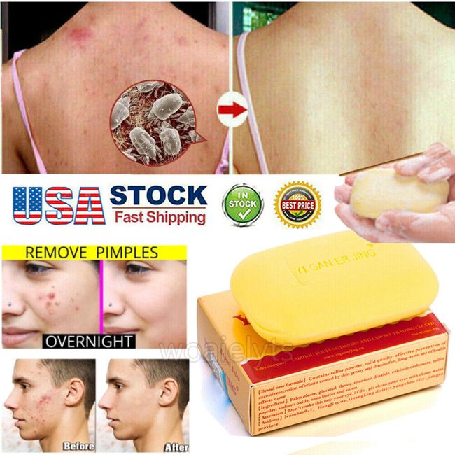 Sulfur Soap Anti Fungal Mites Scabies Acne Treatment Itching Body Bath Soap 80g