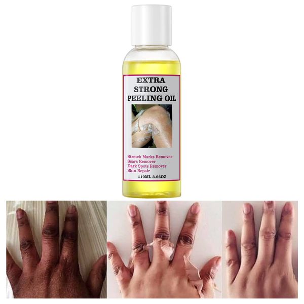 Peeling Oil for Dark Skin, Yellow Peeling Oil with Salicylic Sodium Hyaluronate, Strong Peeling Oil Extra Strength, Exfoliating Peeling Solution for Body All Skin Type - 110ML/3.66 OZ