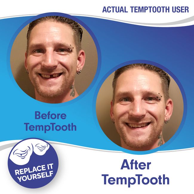 Temptooth #1 Seller Trusted Patented Temporary Tooth India