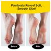 PedEgg Callus Remover Generic Pedicure As Seen On TV  Remove Calluses & Dry