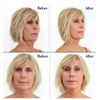 Bring It Up Instant Neck Lift Tape 30 Day Supply, Transparent Neck Lifting Anti Wrinkle Stickers - Tones Sagging Necklines Instantly - Made in USA