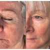 Skin Booster Hyaluronic Acid Authentic