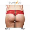 Anti-Acne Thigh & Buttocks Treatment - Clears Away Acne, Pimples, and Ingrown Hairs for the Buttocks and Thigh Area. Prevents Future Breakouts. 6.09 oz
