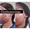 Lise Acne Solution Sunshine Face Kit For All Skin Type 4cs,7day Satisfaction👌