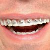 Billy-Bob Fool-All Braces