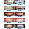 CRYSTAL CLEAR TEETH WHITENING Kit, 2021 Tiktok Trends