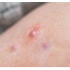 4oz. Hidradenitis Suppurativa cream