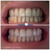Kit de láser para blanquear los dientes Gel blanqueador de dientes profesional