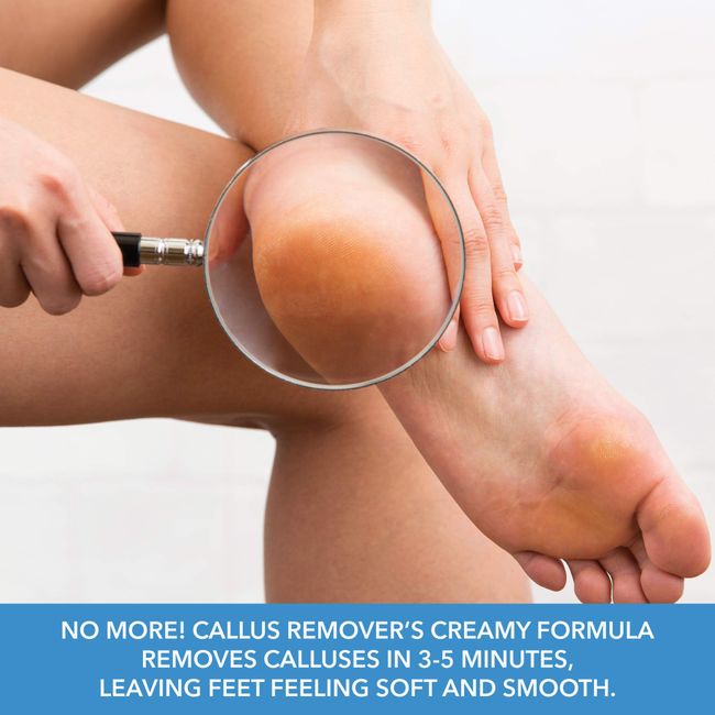 ForPro Premium Callus No More! Callus Remover, Fast-Acting Callus Removing  Formula, 4 oz.