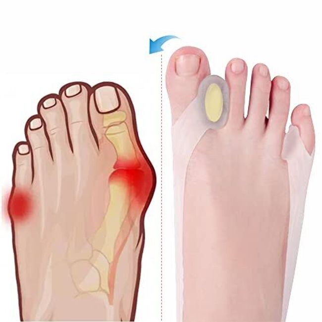 New Generation Toe Separator Toe Corrector Toe spacers for Women can be Adjus...