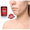 Skin Scars Silicon and Collagen Hydrolyzed Gel Resurfacing Skin Collagen Promoter For Indented Atrophic Rolling Face Scars By ALKA VITA