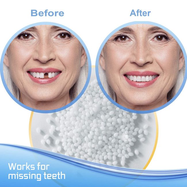 Tooth Repair Kit-Thermal Fitting Beads Granules and Fake Teeth for