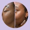 HYPERFADE by ZitSticka, Microdart Patch to Fade Post-Zit Dark Spots (4 Pack)