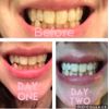 Smile Titan Teeth Whitening Kit with LED Light, 3 Carbamide Peroxide Teeth Whitening Gel Express Teeth Whitener. Remove Stains from Coffee, Smoking, Wine, Food (5 Piece Set)