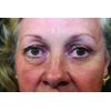 RX Flawless Eyes - 1 x 10ml Bottle. 100 Applications