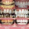2PCS Niacinamide Whitening Toothpaste Niacinamide Intensive Whitening Toothpaste