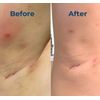 4oz. Hidradenitis Suppurativa cream