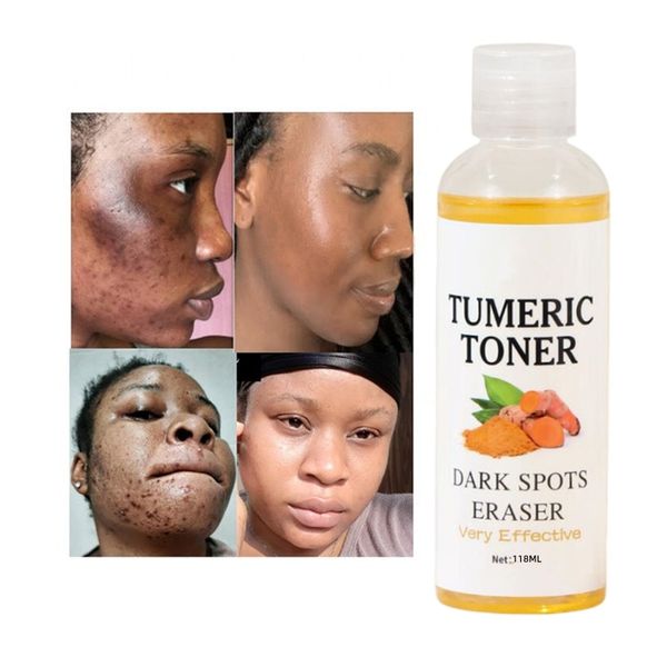 118ml Tumeric Dark Spot Toner Facial Strong Lightening TurmericToner Spots Eraser Skin Tone Perfect Skin