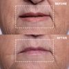 Mouth Wrinkle Patches Reusable Silicone for Targeted Skin Refinement