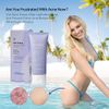 Tobcharm Back Acne Treatment, Butt Acne Clearing Cream, Body Acne Treatment with Azelaic Acid 3.4 fl. oz., Great for Men and Women Acne Scar Treatment, Hormonal Acne And Cystic Acne Treatment
