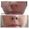 Demodexcillin Skin Solution 4 Fl.Oz Recommended For Acne, Rosacea, Blepharitis