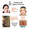 LARGE SURFACE STRIPS, Acne Strips, Rectangle Pimple Patches, FACE SPOT STICKERS