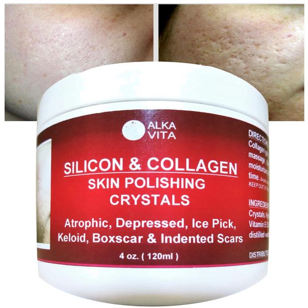 Alka Vita Acne Scars Silicon & Collagen Skin Polishing Crystals Gel For Indented Rolling Atrophic & Keloid Scars Natural Ingredients By, Clear, 4.0 Fl Oz, (Pack of 1)