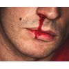 Nasalcease FirstAid Nosebleeds, 5-Count Box